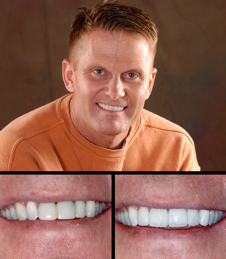 Doug was unhappy with bridgework replacing an upper front tooth.  After bleaching his teeth, we replaced the bridge with an implant and three individual porcelain crowns.