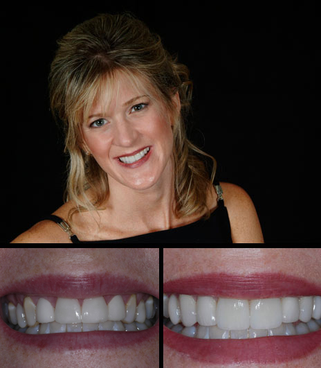Kelly was unhappy with the crowns on her four upper front teeth. We gave her six new crowns and did some gum contouring to improve her smile