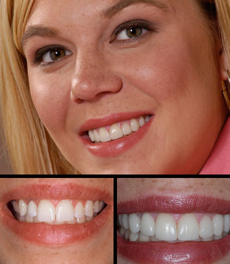 Kristen was congenitally missing (born without) an upper front tooth and was unhappy with the length of her teeth.  She had cosmetic gum contouring, orthodontic care (to make room for an implant), tooth bleaching, an implant crown, five porcelain crowns and four veneers.