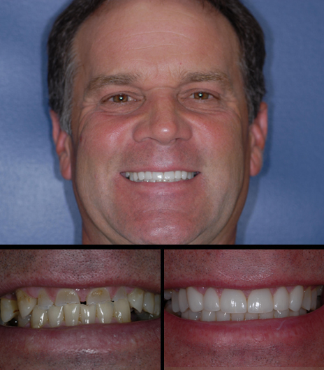 Changing this age-worn smile involved bleaching, crowns, implants, veneers and gum contouring.
