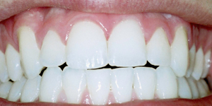 Bleaching After