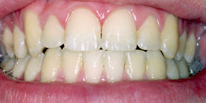 Bleaching Before
