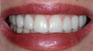 cosmetic porcelain veneers with a Comstock Park dentist Rockford MI