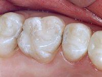 tooth colored filling