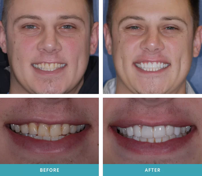 Smile Makeovers Cosmetic Dentistry Comstock Park Teeth Whitening