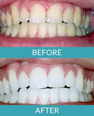 Photo of a Grand Rapid’s patient’s teeth before and after a teeth whitening session in Comstock Park.