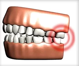 An inflamed TMJ can cause TMD for patients in Grand Rapids.