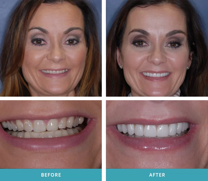 Patient with twelve new porcelain crowns and veneers from the Comstock Park dentist at Eric Hull DDS Aesthetic & General Dentistry.