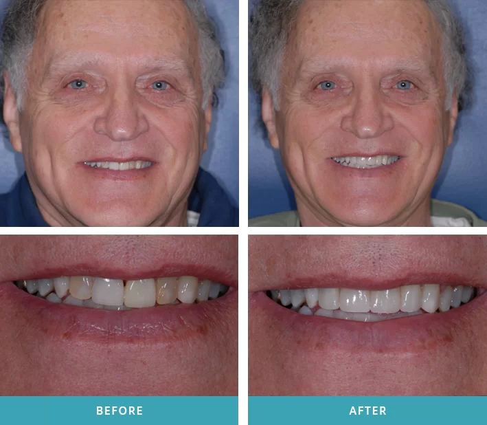 Patient with two porcelain veneers and crowns that he received from a dentist near Grand Rapids, MI.