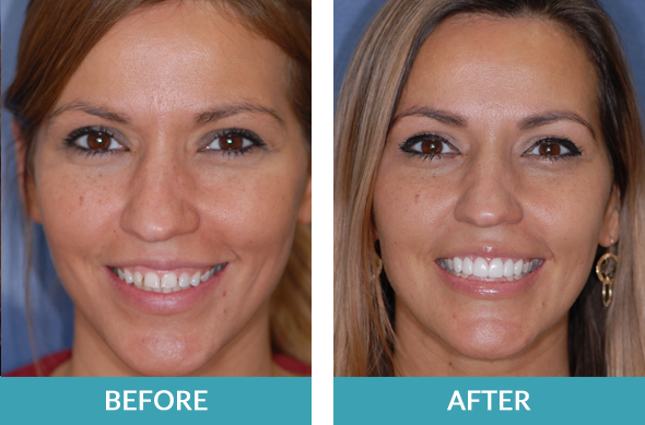 Cosmetic crown lengthening procedure followed by six veneers.