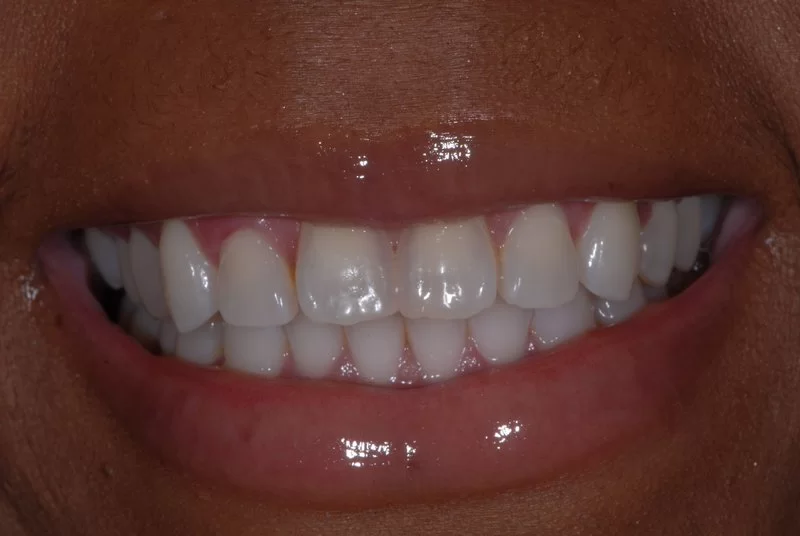 Patient has imperfect teeth without porcelain veneers.