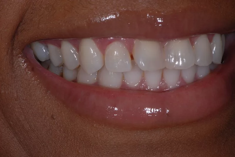 Patient near Rockford MI in need of dental veneers.