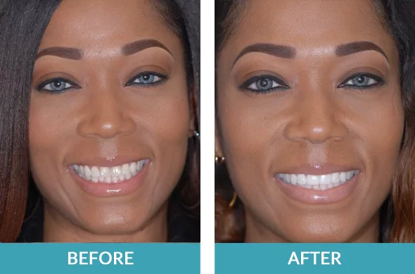 Cosmetic Dentistry Before After Photos, Porcelain Veneers Pictures