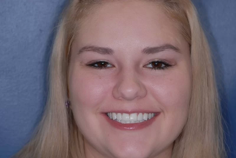 Patient after her teeth veneers were applied by the expert cosmetic dentists at Eric Hull DDS Aesthetic & General Dentistry.