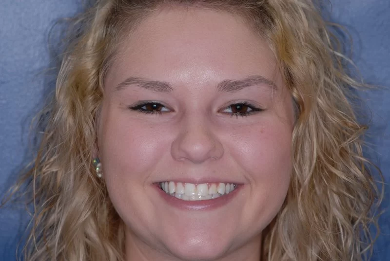 Patient smiling near Grand Rapids before her porcelain veneers were applied.