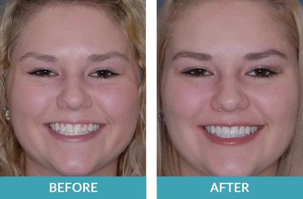 Porcelain teeth veneers case on a patient from Grand Rapids, MI.