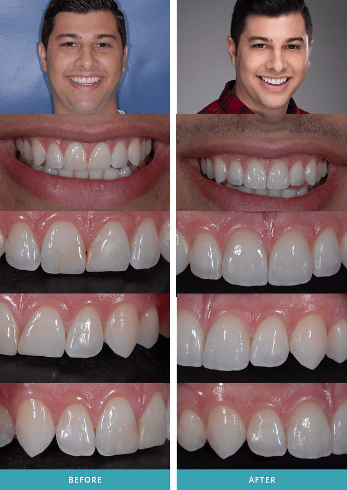 Porcelain dental veneers case with a patient from Grand Rapids, MI.