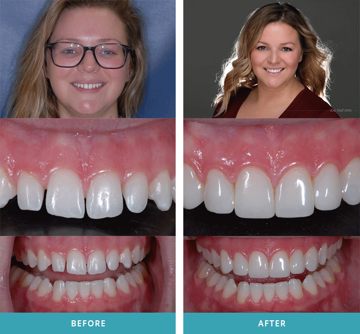 Smile Gallery - Cosmetic Dentistry Before and After Grand Rapids | Eric  Hull DDS - Comstock Park Dentist