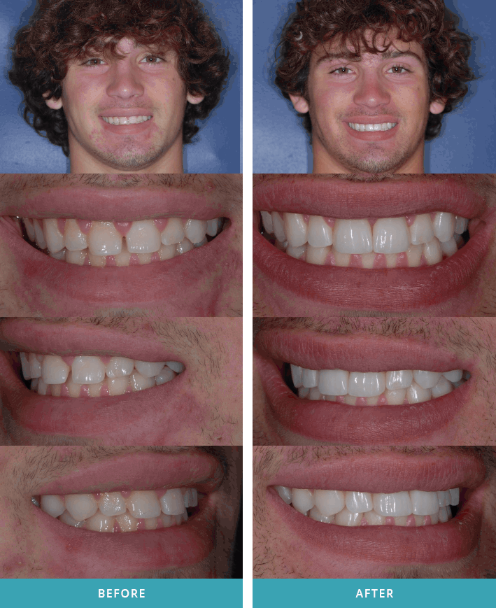 Patient showing off one dental veneer and one tooth crown in Comstock Park.