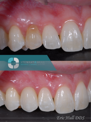 before and after photos of a tooth implant and crown by Dr. Eric Hull in Comstock Park MI