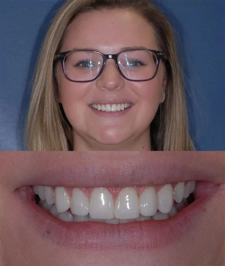 After cosmetic dental bonding by Dr. Eric Hull, a cosmetic dentist near Grand Rapids, MI