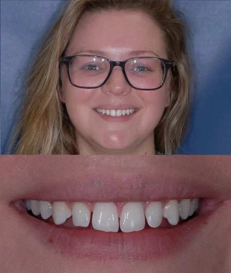 Before composite dental bonding by Dr. Eric Hull in Comstock Park, MI