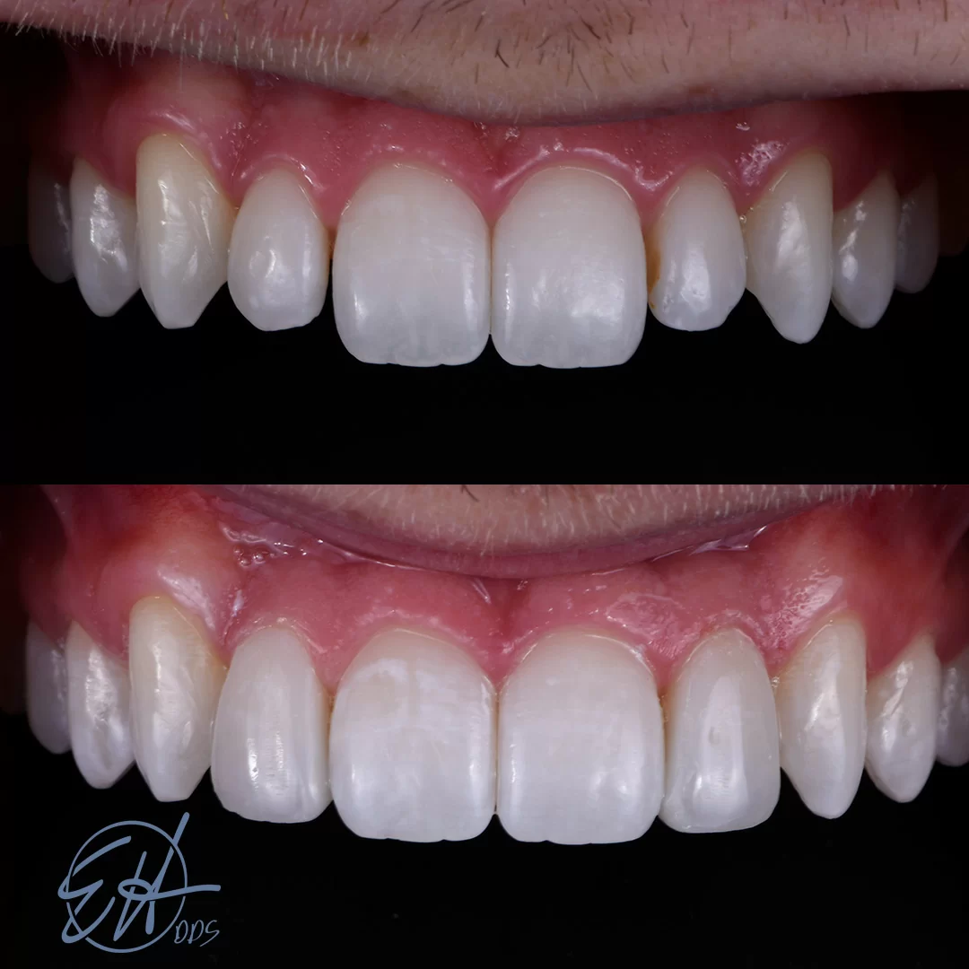 Patient received cosmetic bonding from Dr. Hull, a Comstock Park dentist.