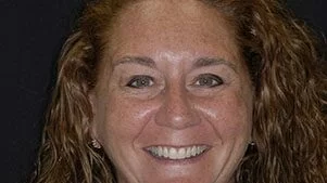 Actual Patient: One Veener and One Crown Man from Grand Rapids who received Invisalign in the past came in to have one veneer and one crown applied.