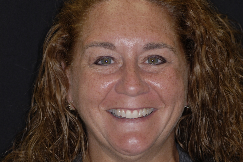 Photo of patient with a transformed smile thanks to porcelain veneers.