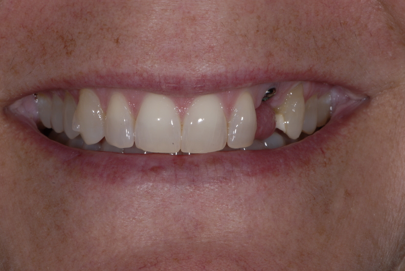 Patient near Rockford MI in need of dental veneers.