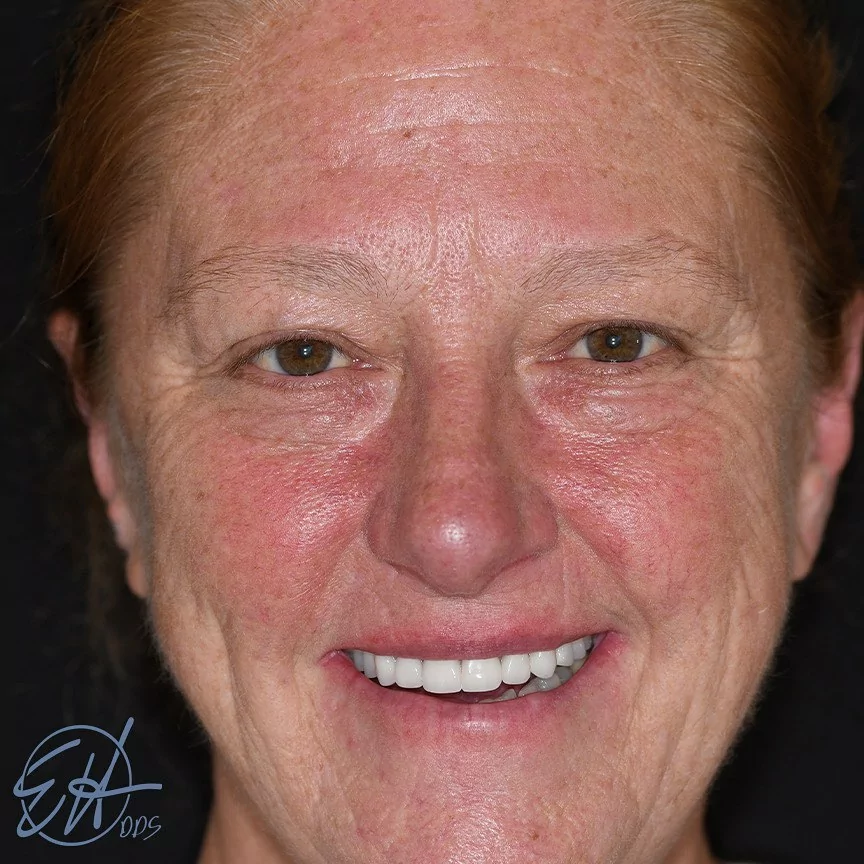 Dental Implant Placement After - Dental Implants Grand Rapids MI