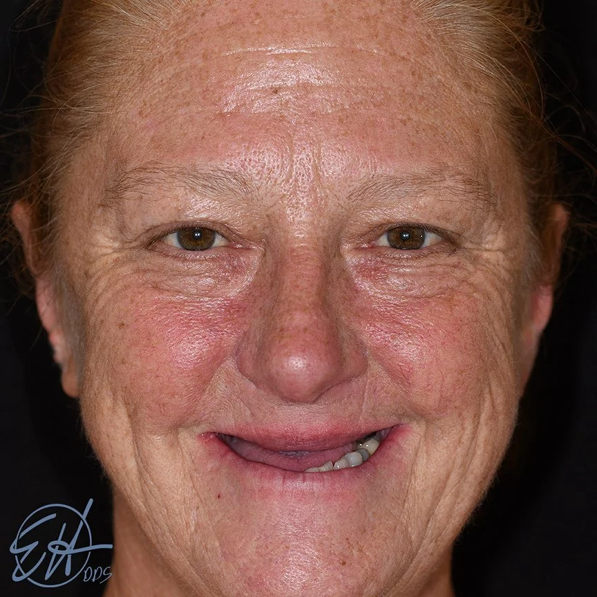 Before Dental Implant Placement - Dental Implants Grand Rapids MI