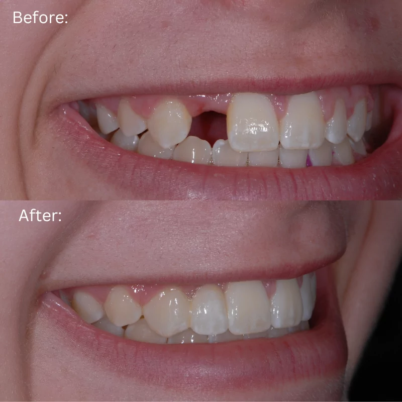 Tooth Replacement Options - Eric Hull Aesthetic & General Dentistry ...