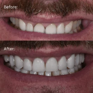 Before and after photo of full mouth reconstruction patient Brads smile transformation