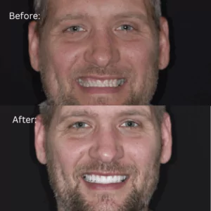 Full Face before and after photo of full mouth reconstruction patient Chris smiling wide to show off his new smile!