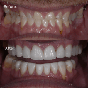 Before and after photo of full mouth reconstruction patient Chris with lips retracted to show changes in smile