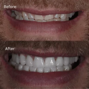 Before and after photo of full mouth reconstruction patient Chris to show changes in his new smile