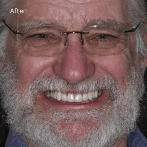 Full Face after photo of full mouth reconstruction patient Ken smiling wide to show off his new smile!