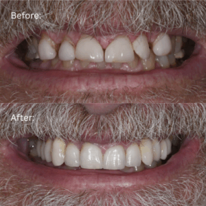Before and after photo of full mouth reconstruction patient Ken to show changes in his new smile