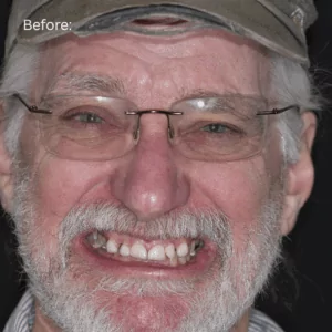 Full Face before photo of full mouth reconstruction patient Ken smiling wide to show off his smile before the transformation.