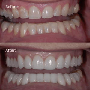 Before and after photo of full mouth reconstruction patient Lori with lips retracted to show changes in her smile