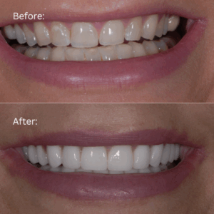Before and after photo of full mouth reconstruction patient Lori to show changes in her new smile