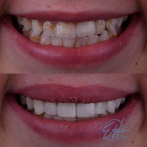 Alexis Before and After Injection Molding case