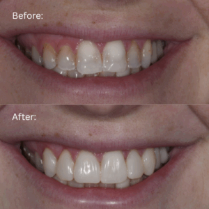 Before and After Amanda Injection Molding