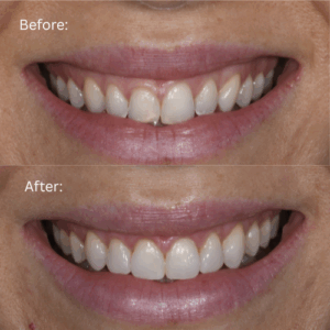 Before & After Anastasia Injection Molding