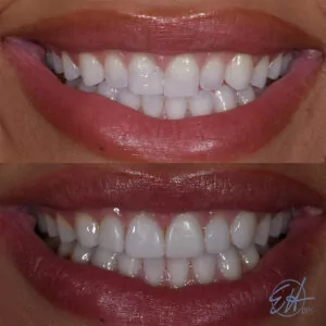 Jane Before and After Injection Molding
