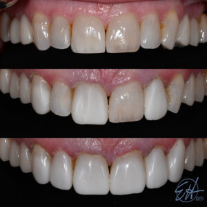 Progression photo of Shelly Injection Molding case