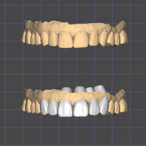 Shelly Injection Molding case digital impressions