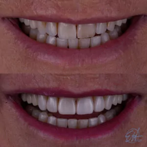 Shelly Before and After Injection Molding case