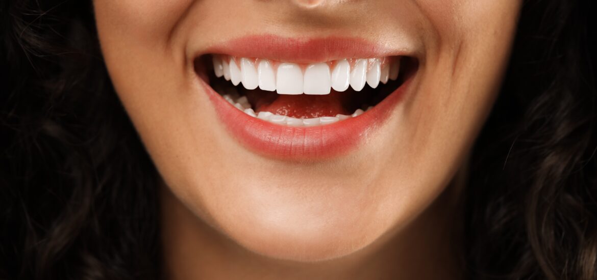 close-up of a woman showing her perfect smile, composite veneers